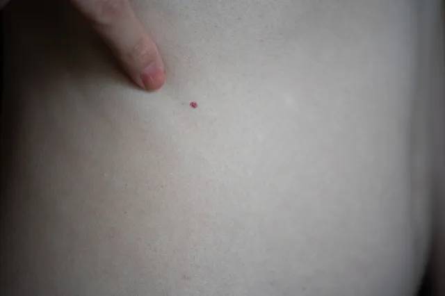スピリチュアル 赤いほくろの意味と場所で当たる占い