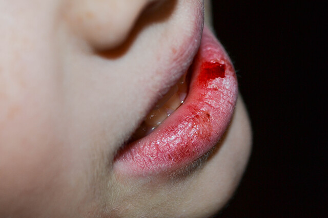 唇の怪我