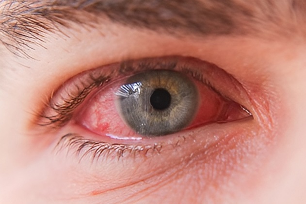 目の病気　結膜炎